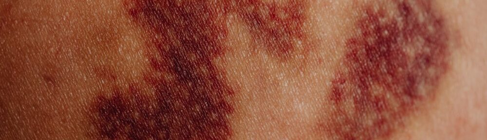 Strengthen Your Immunity Against Lyme Disease in Arizona